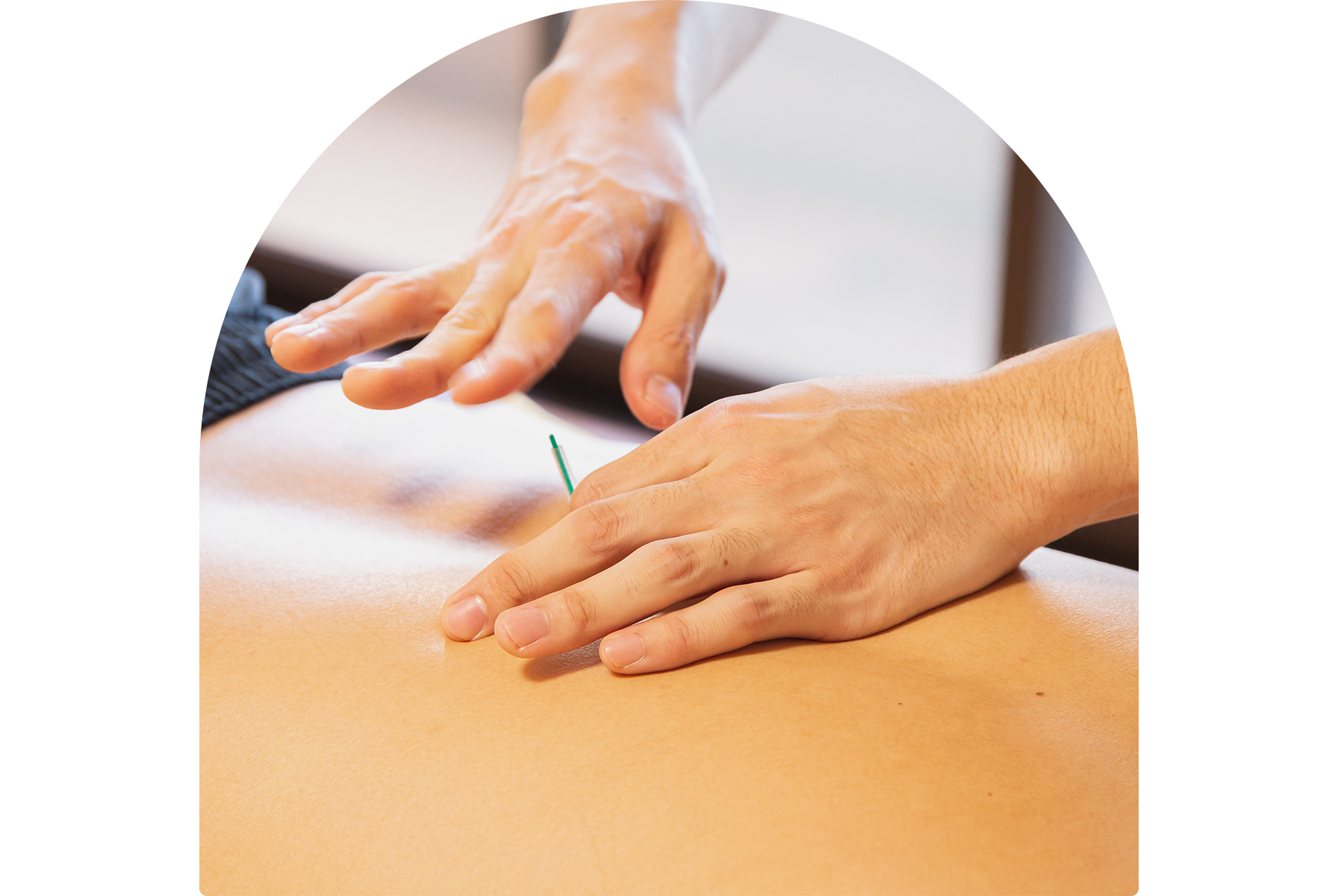 Acupuncture